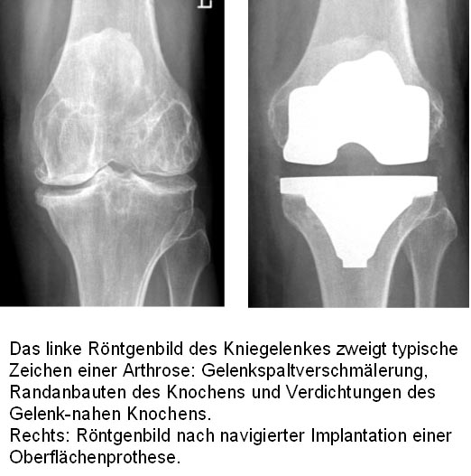 Arthrose Hinter Der Kniescheibe Op