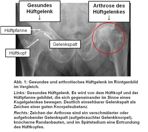 Arthrose des Hüftgelenks | Sana Klinikum Hameln-Pyrmont
