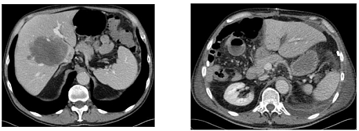 CT Bilder vor und nach einer erweiterten Leberresektion